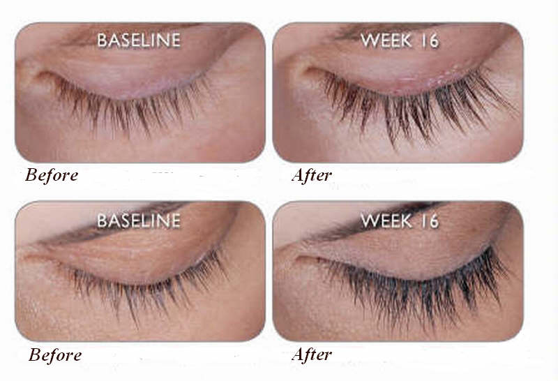 Latisse_before_after